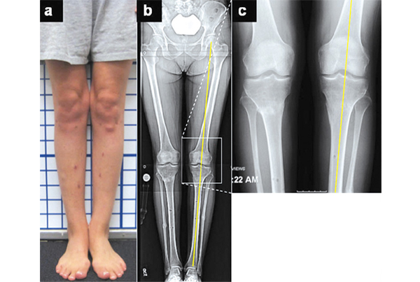 Deformity Correction (Ilizarov/ LRS)