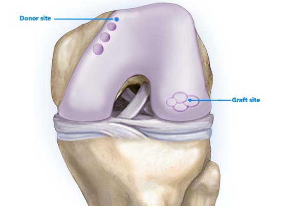 AVN management and Joint Preserving procedures (Chondroplasty/ ACI/ OATS)