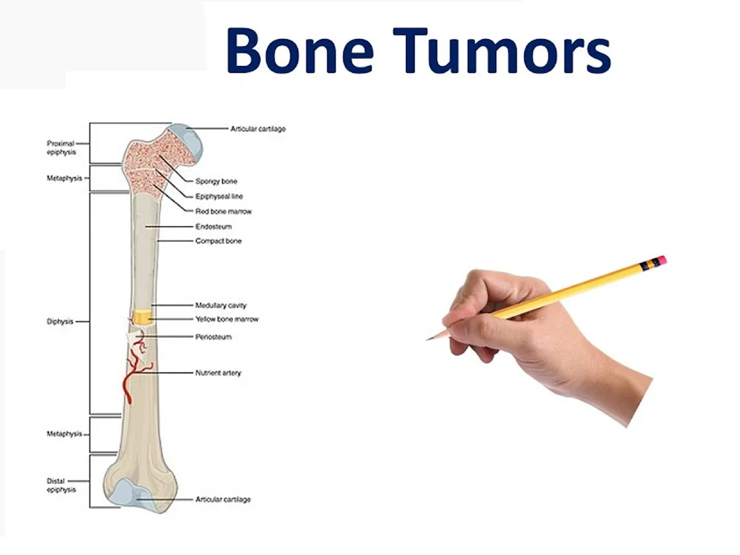 Metabolic Bone Disorders and Bone Infection Management