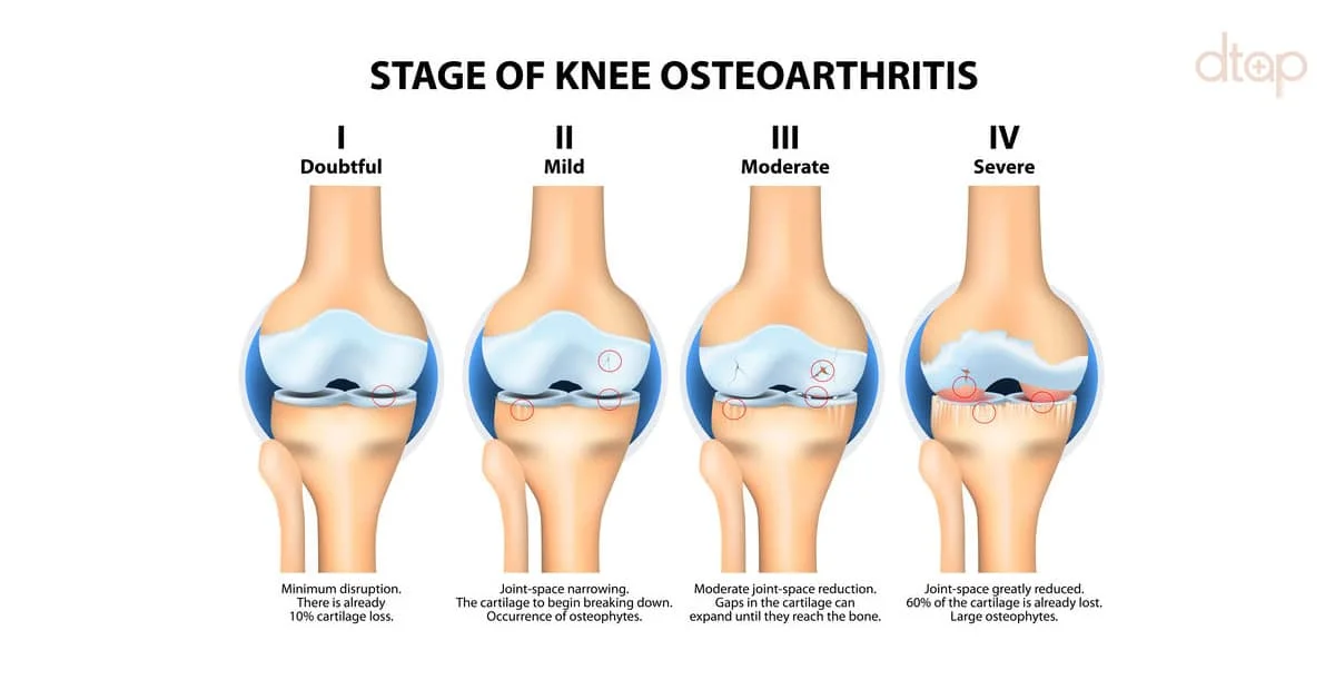 TOTAL KNEE REPLACEMENT