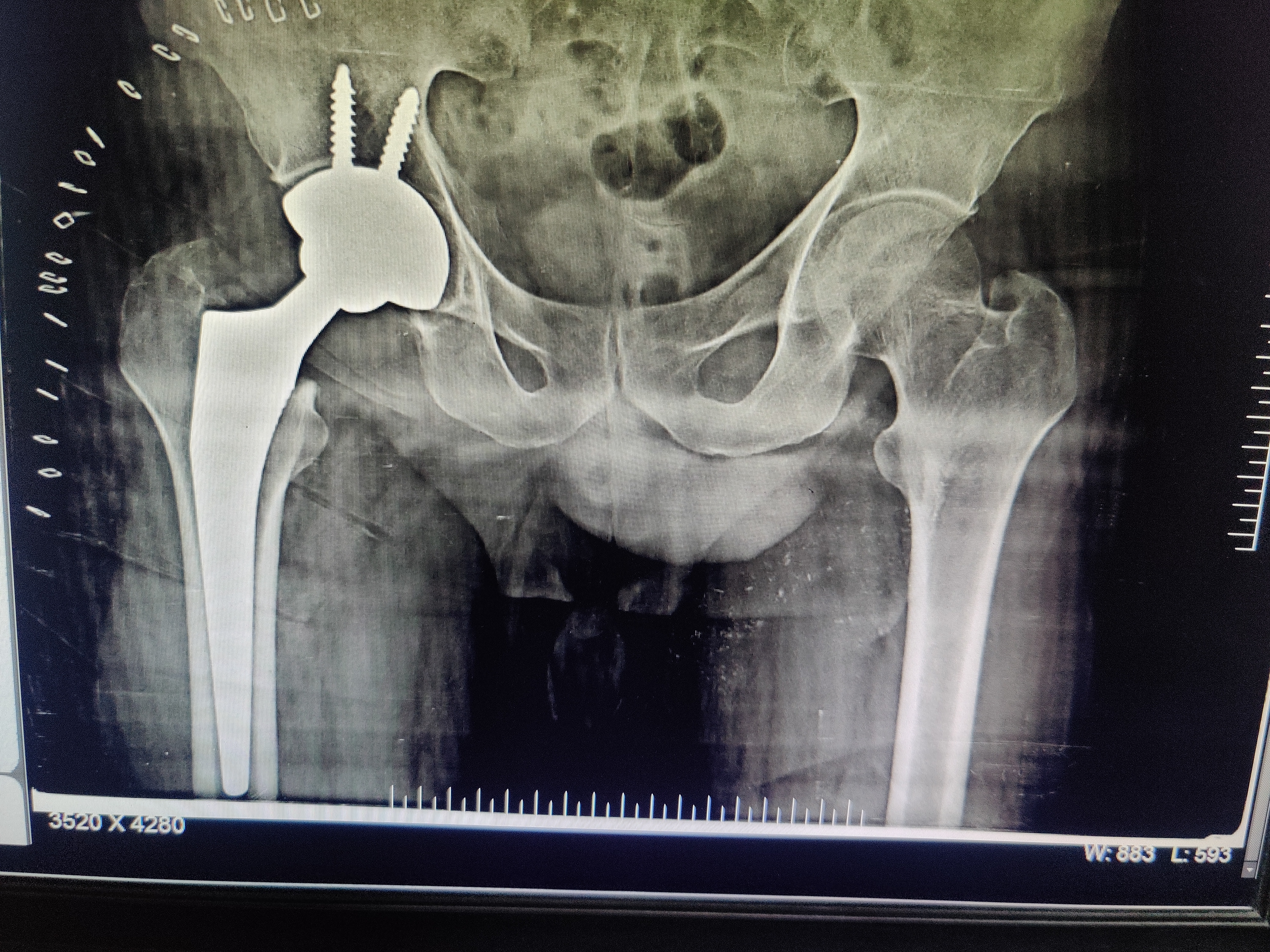 TOTAL HIP REPLACEMENT