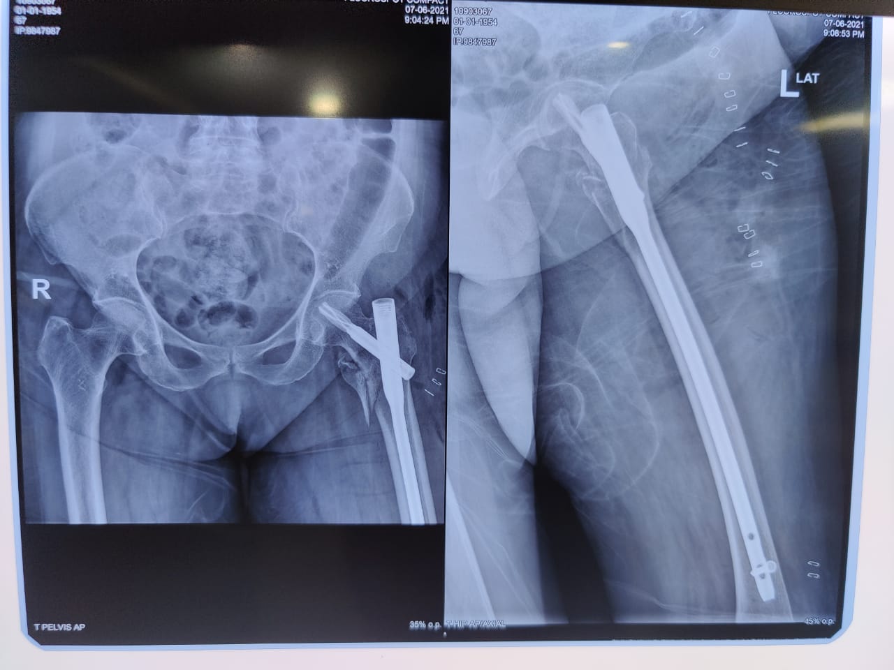 FRACTURE MANAGEMENT