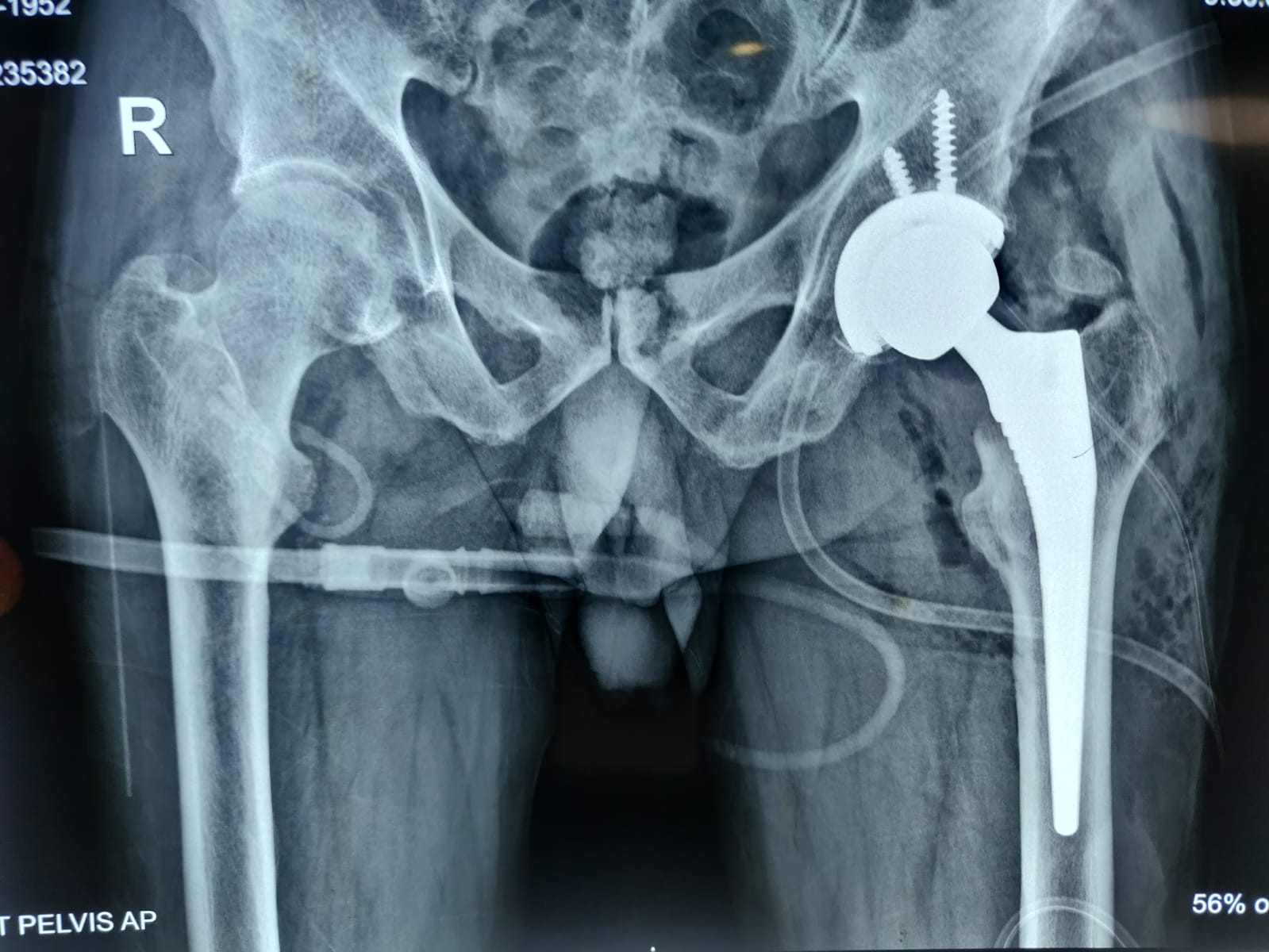 TOTAL HIP REPLACEMENT