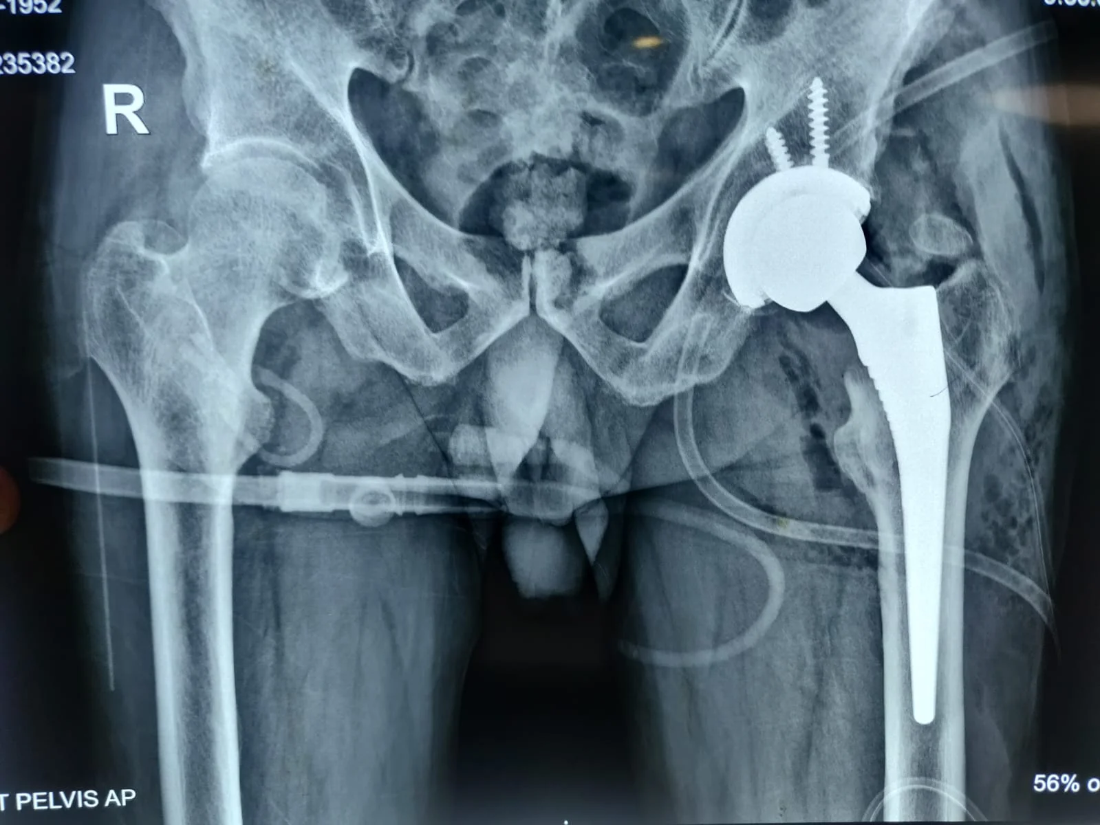TOTAL HIP REPLACEMENT