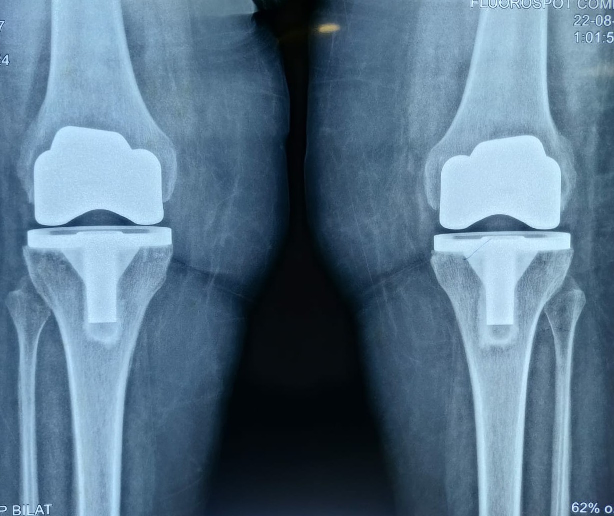 TOTAL KNEE REPLACEMENT