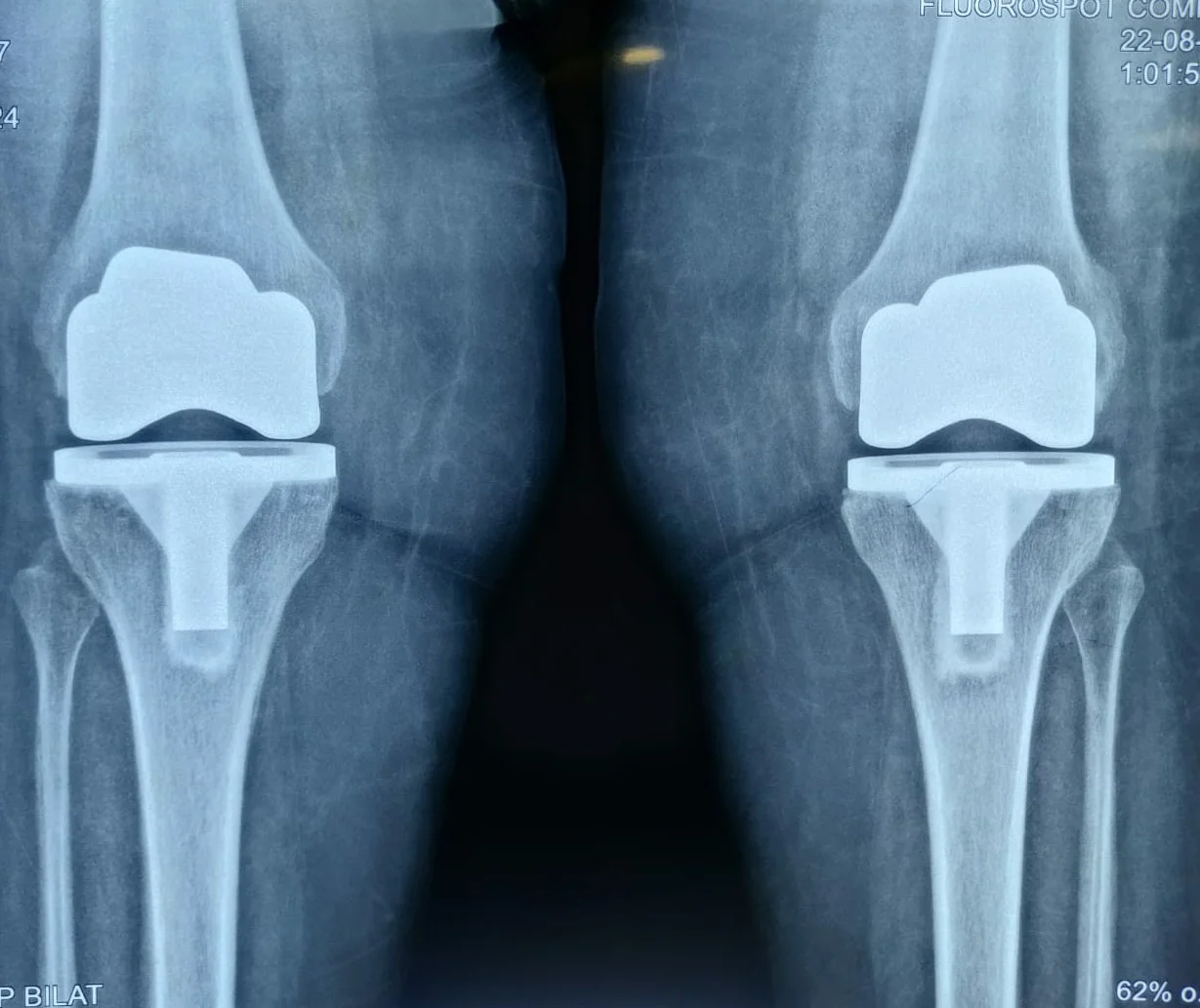 TOTAL KNEE REPLACEMENT
