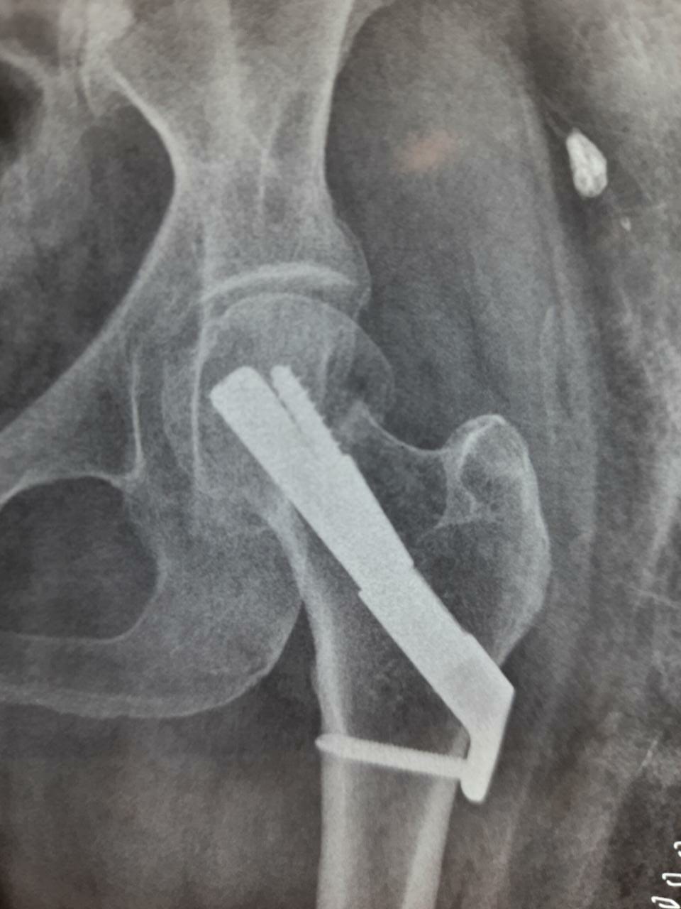 PRIMARY/COMPLEX FRACTURE 