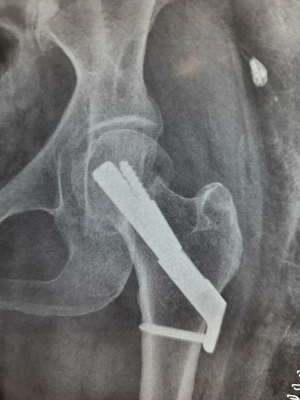 PRIMARY/COMPLEX FRACTURE 