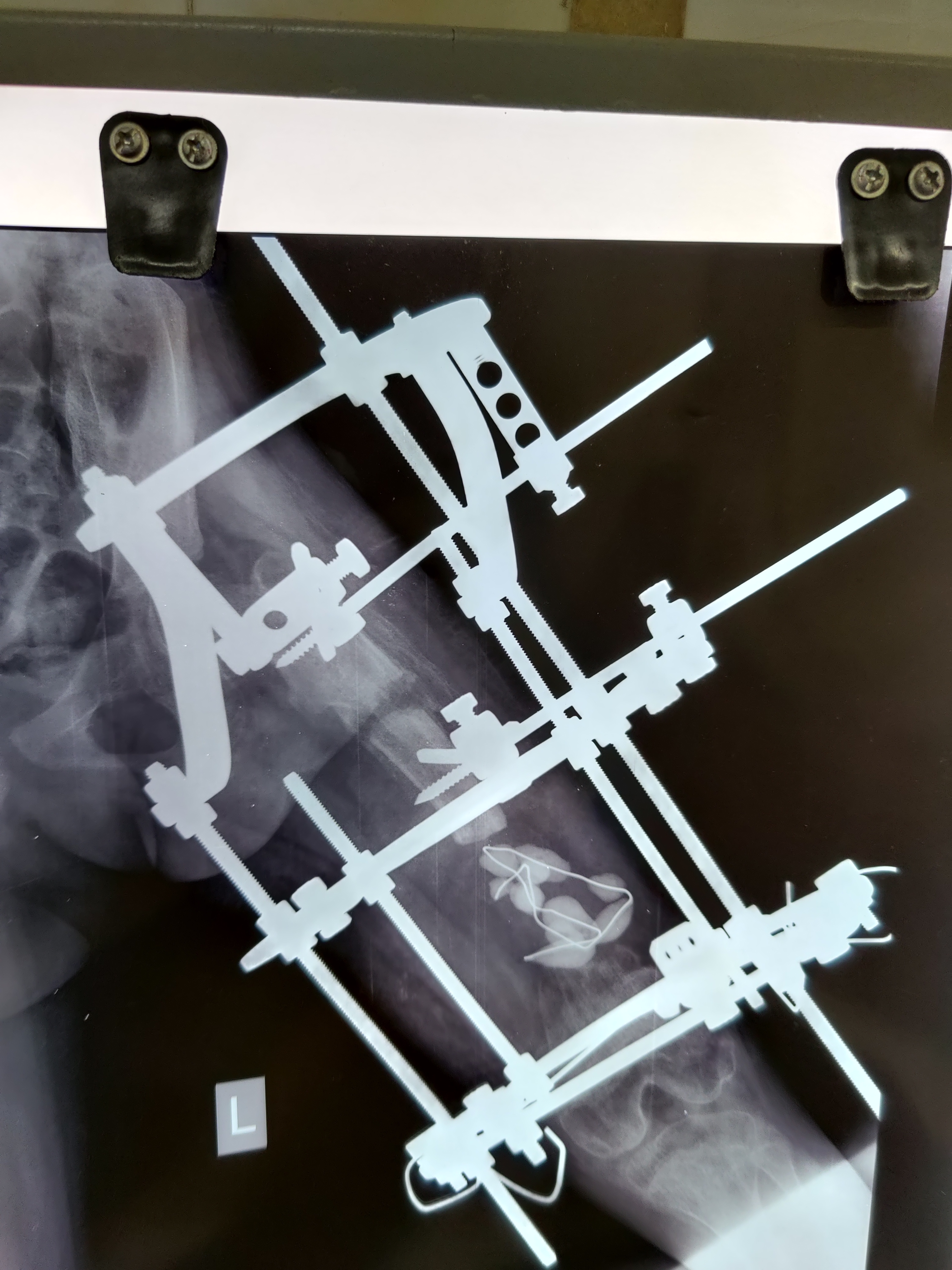Deformity Correction (Ilizarov/ LRS)