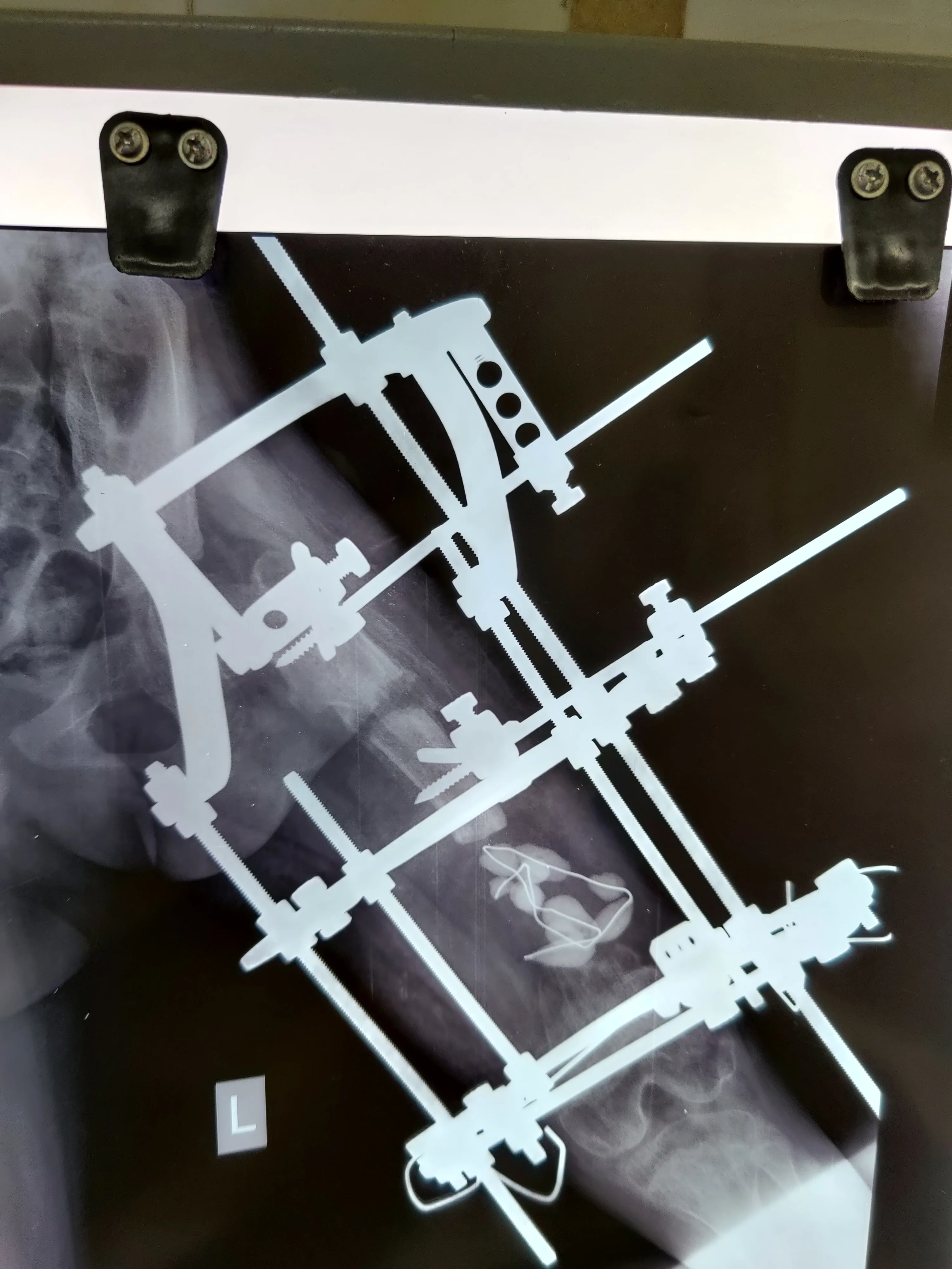Deformity Correction (Ilizarov/ LRS)