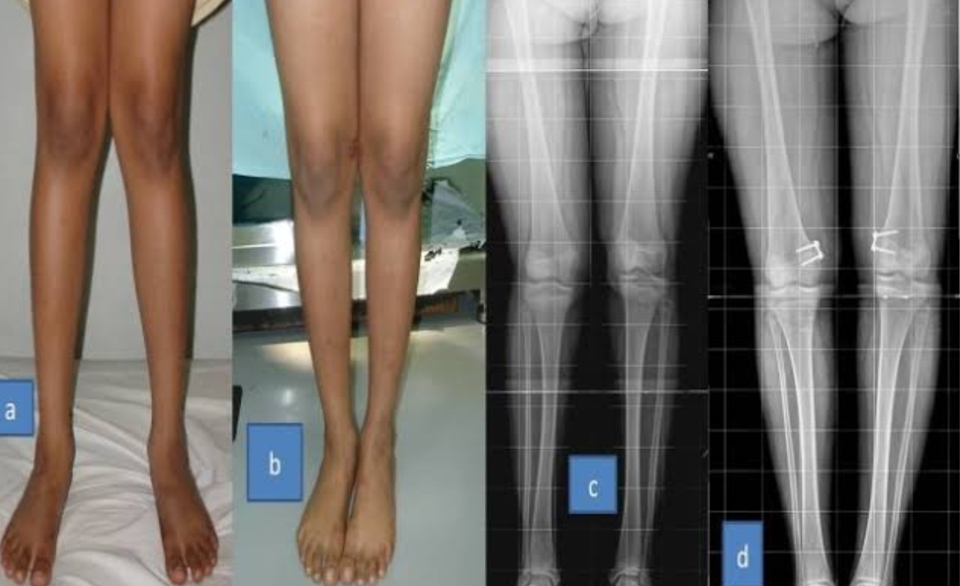CTEV management and Paediatric Orthopaedic Disorders