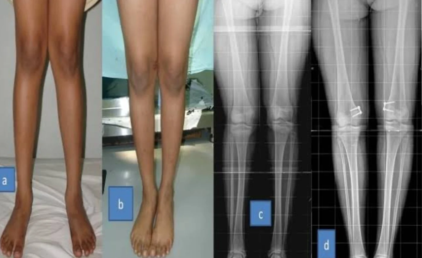 CTEV management and Paediatric Orthopaedic Disorders