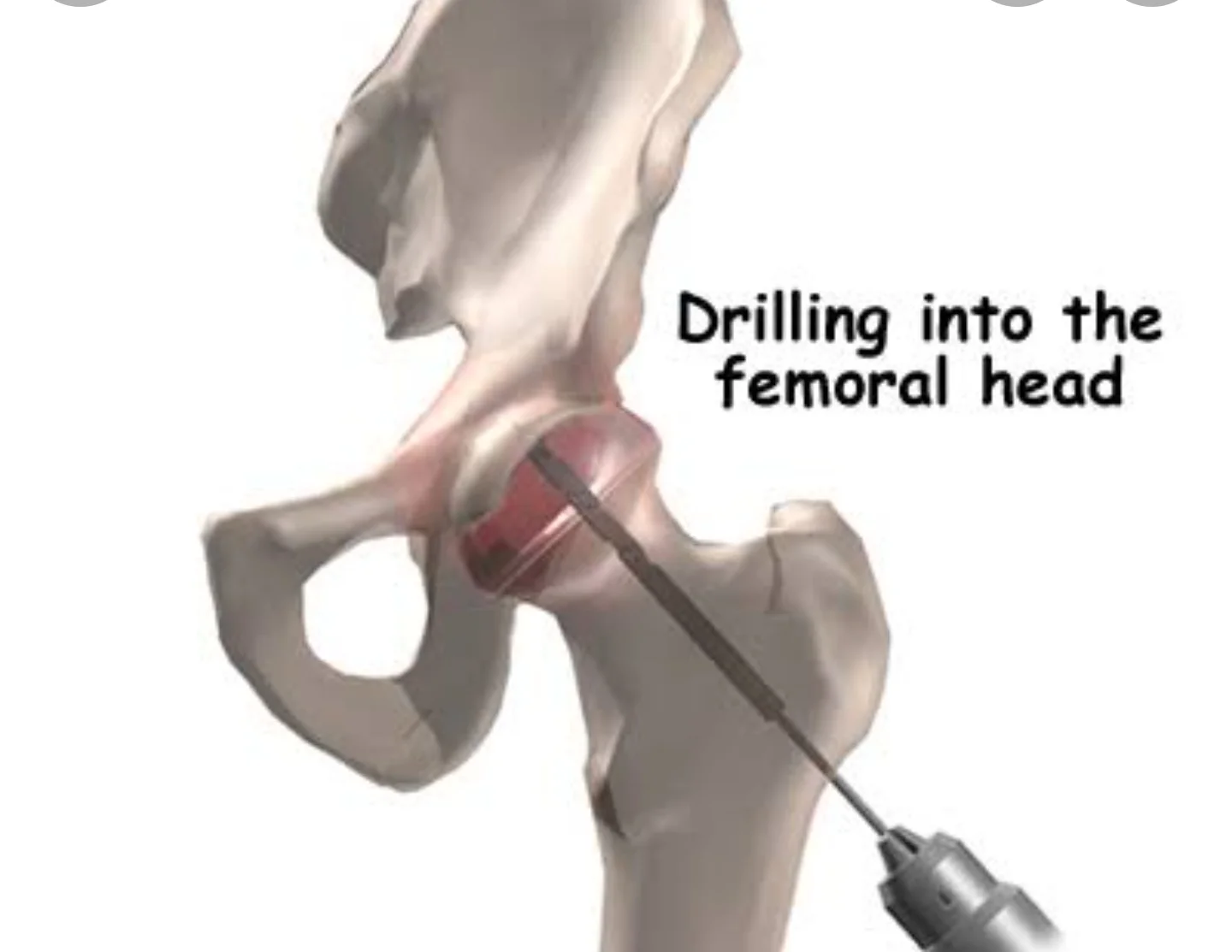 AVN management and Joint Preserving procedures (Chondroplasty/ ACI/ OATS)