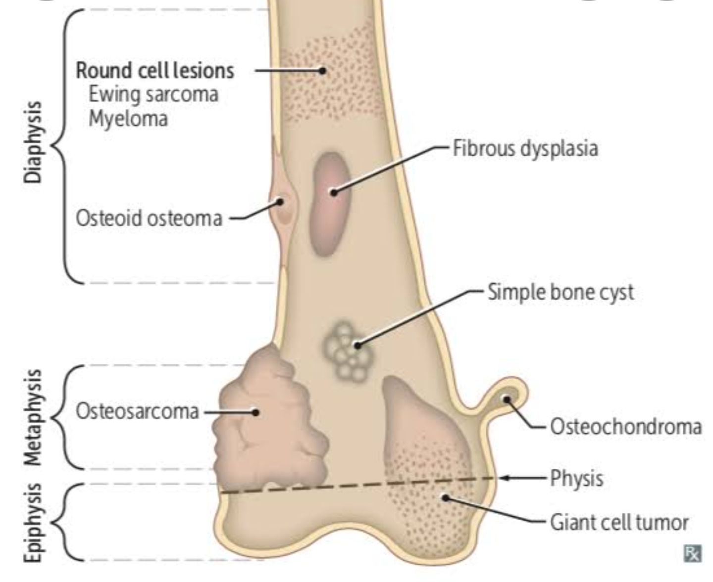 Orthopedic Tumours Management