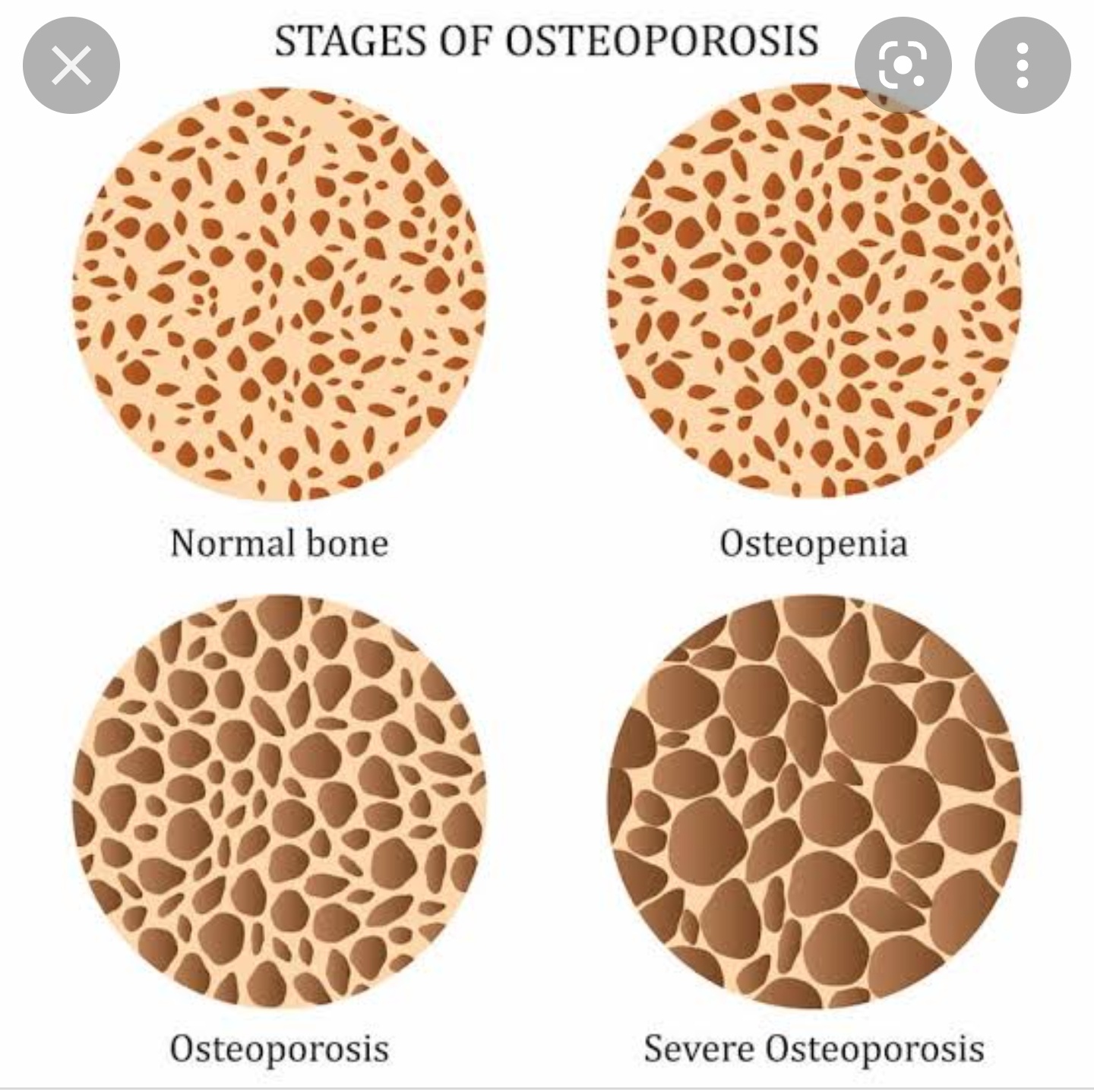 Metabolic Bone Disorders and Bone Infection Management