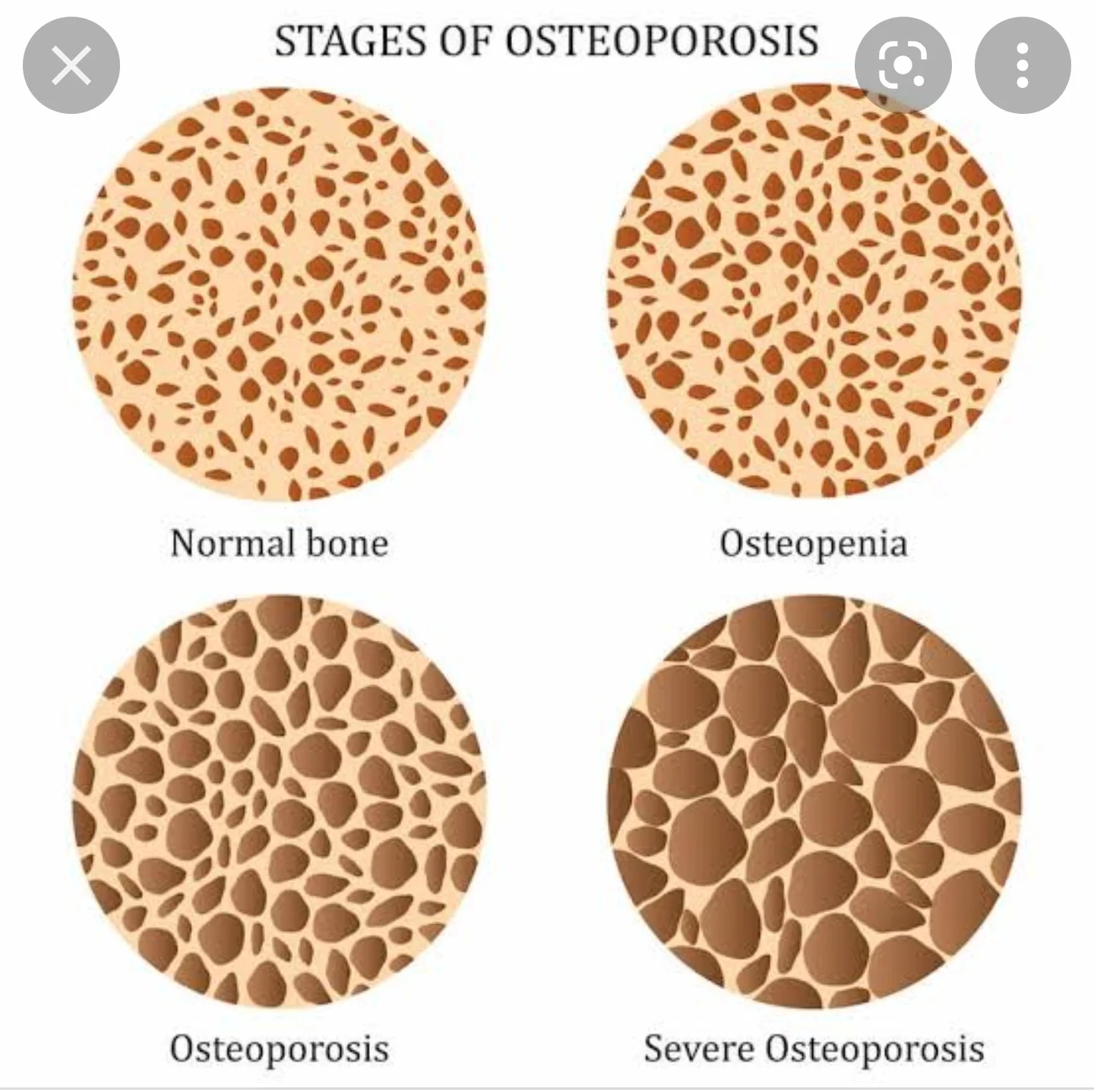 Metabolic Bone Disorders and Bone Infection Management
