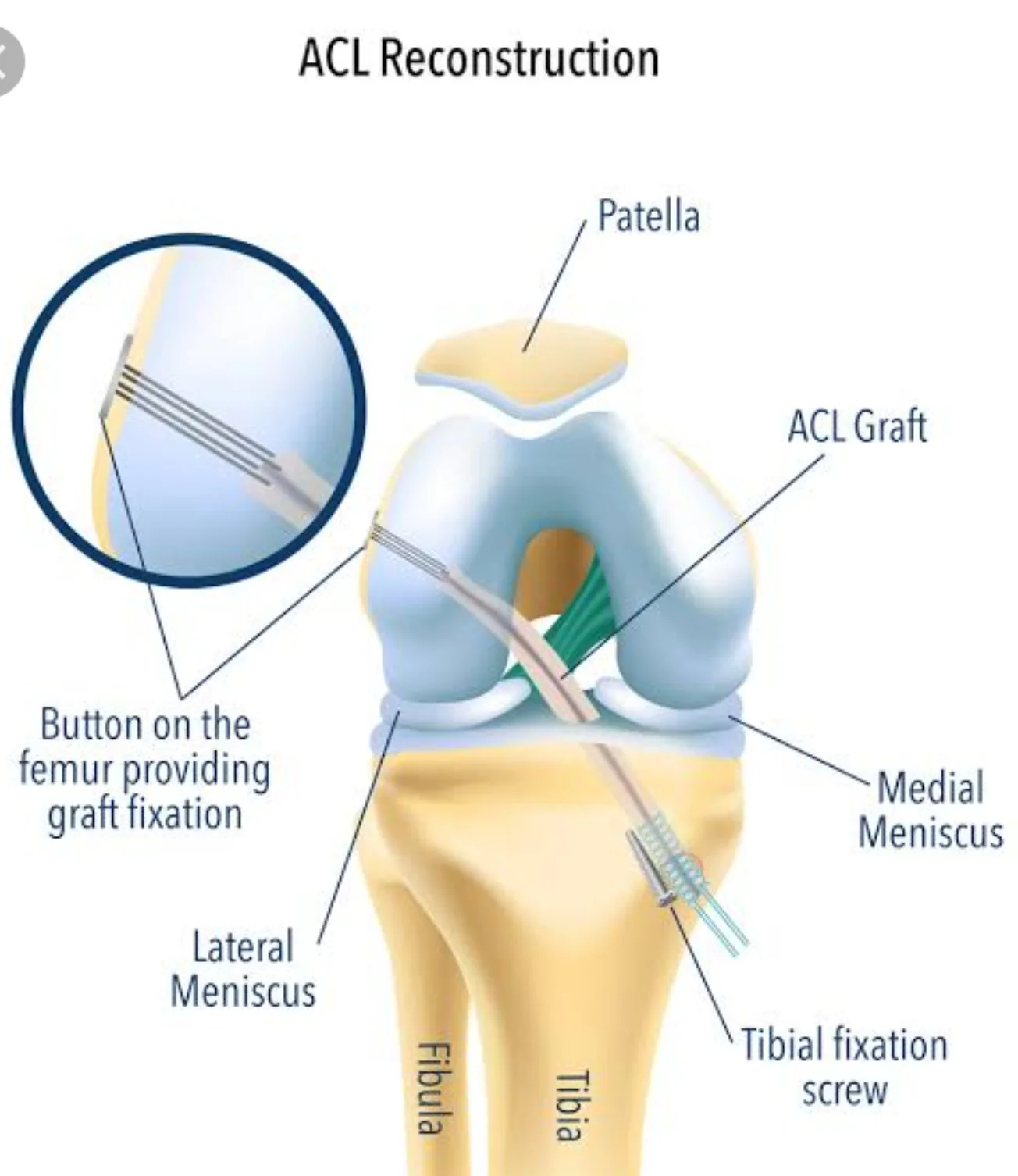 ACL RECONSTRUCTION